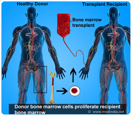 Bone-Marrow-Transplantation