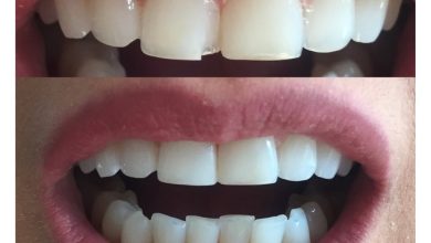 dental bonding resin