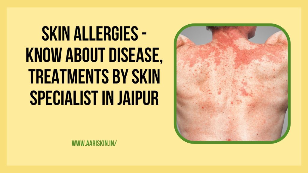 Skin Allergies