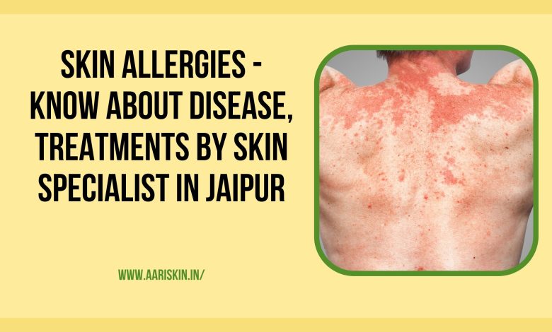 Skin Allergies