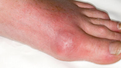 Gout