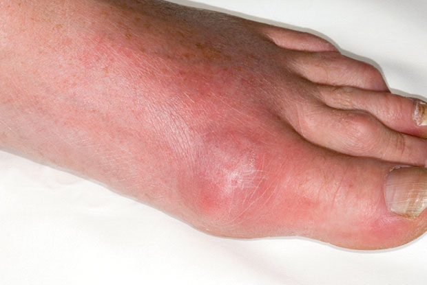 Gout